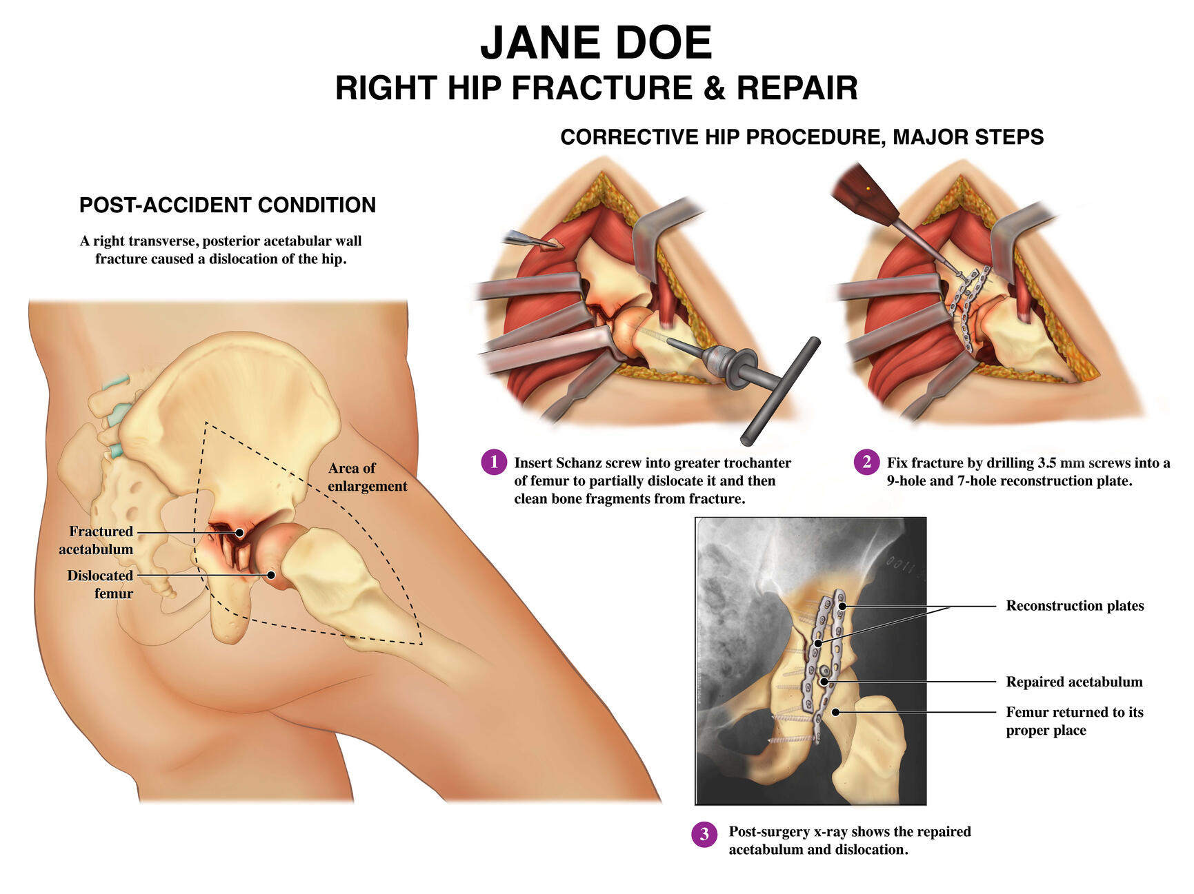 Jane Doe Med Legal – 30"x40" Adobe Photoshop, Illustrator
