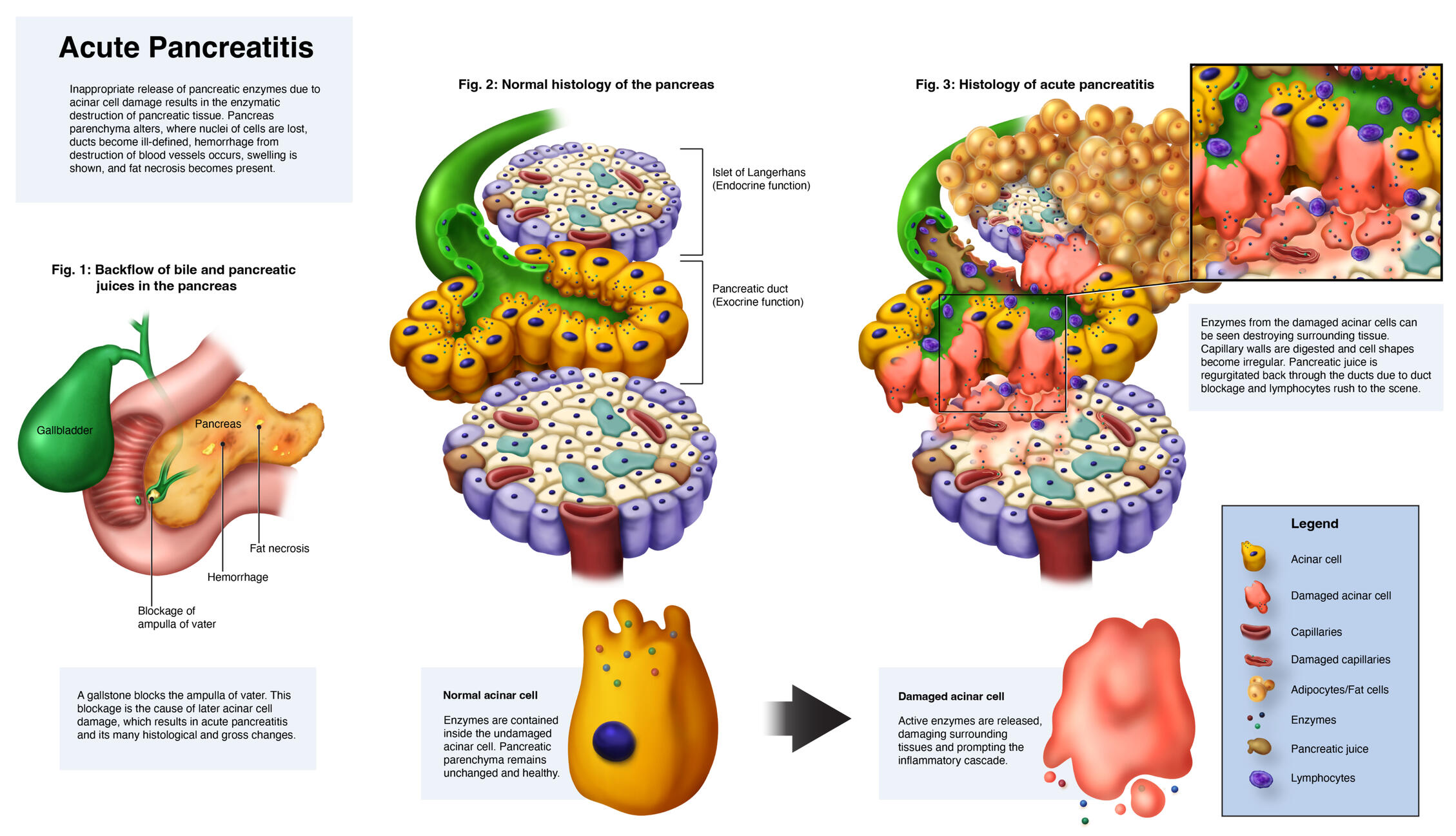 Histopathology of Acute Pancreatitis – Clip Studio Paint EX, Adobe Illustrator