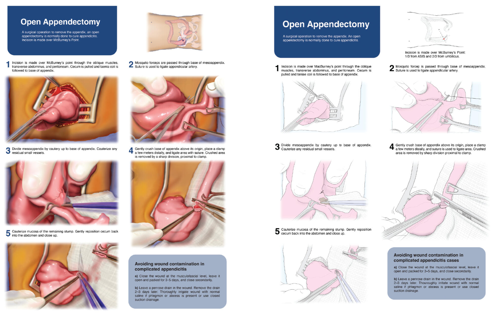 Open Appendectomy: Final (L), Detailed Sketch (R) – Adobe Illustrator, Photoshop