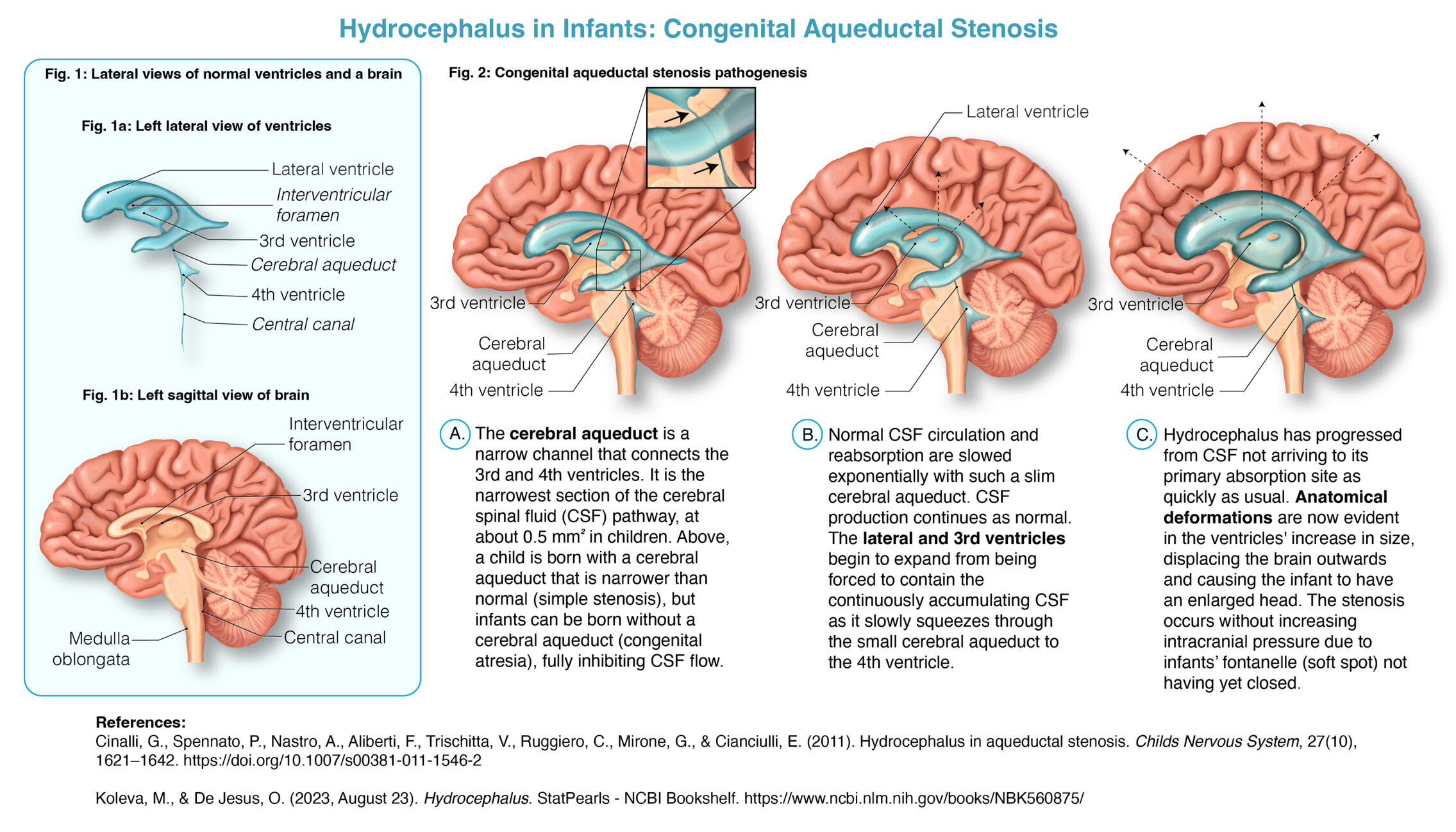 Pathophysiology of Hydrocephalus in Infants – Procreate, Adobe Illustrator