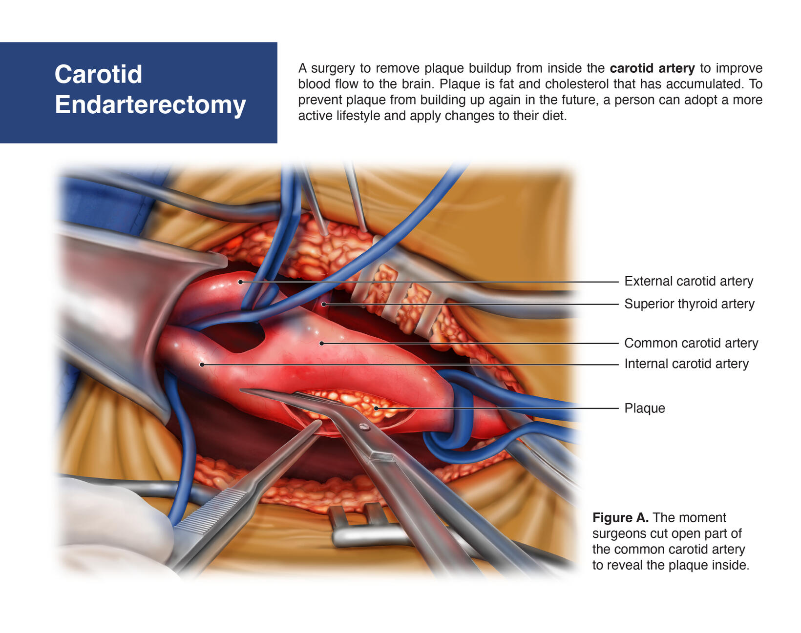 Carotid Endarterectomy – Adobe Photoshop, Clip Studio Paint EX